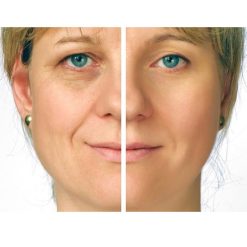Dream Face Acne Removing Fairness Cream